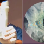 Médico faz alerta após jovem ser internado com desodorante no reto