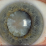 Saiba mais sobre a catarata e como funciona o tratamento da doença