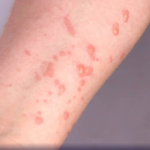 Casos de mpox sobem para 13 em Minas Gerais