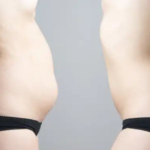 Gordura abdominal: o que fazer para perder barriga de forma saudável